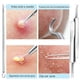 thumbnail image 3 of Blackhead Remover Pimple Extractor Tool Kit Stainless Steel Needles Scraper Comedone Blemish Pores Cleansing Tool, 3 of 4
