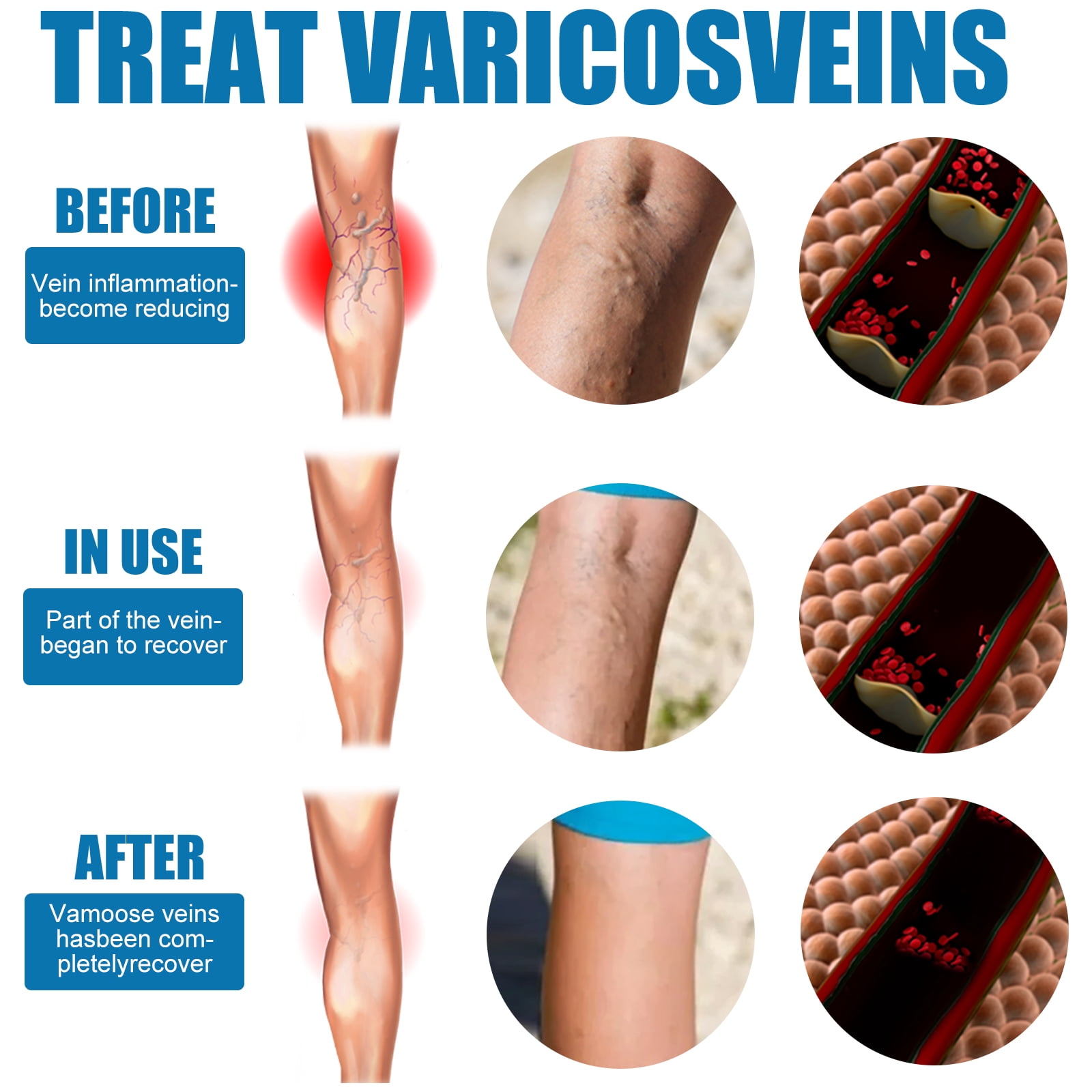 Alvantor Body Spray for Veins Leg Treatment with Herbal Formula, Relieves Tired Heavy Legs, 1.05oz