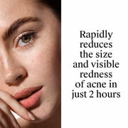 Neutrogena Rapid Clear Acne Spot Treatment, Benzoyl Peroxide 10% Pimple Cream, 1 oz
