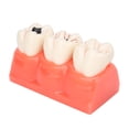 thumbnail image 2 of Oubit Modèle de Dents Caries Simulation, Modèle de Dents Caries Détachable Modèle de Dents Caries Dentaires Modèle Polyvalent, 2 of 9