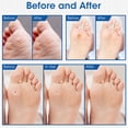 thumbnail image 5 of 2026 Corn Removers For Feet, 24 Pack Corn Removers For Toe, Foot Corn-Toe Corn-Callus Removal, Corn Remover Feet, 5 of 7