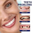 thumbnail image 2 of Braces Beauty Teeth Guard Teeth At Night Sleep Bite Anti-Grinding Teeth Clean Teeth Protection Teeth Invisible Braces, 2 of 5