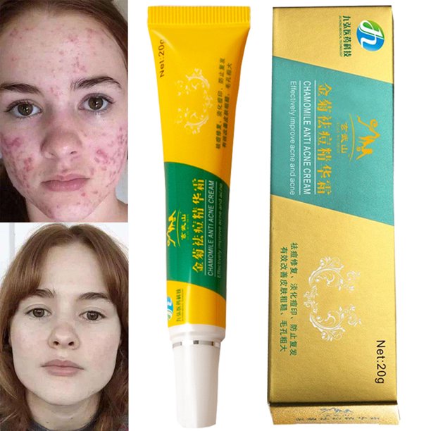 Herbal Chamomile Acne Removal Cream Skin Care Acne Traditional Chinese