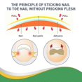 thumbnail image 4 of Jaysuing Toenail Groove Correction Sticker Nail Repair Correction Pull-up Sticker Toe Ingrown Nail Manicure Nail Straightening Sticker -, 4 of 5