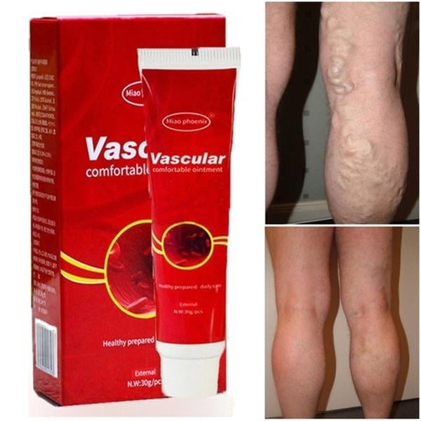 varicoza vasculara vasculara vasculara