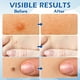 thumbnail image 5 of Gel eliminador de verrugas Uosfsrr con ácido salicílico, 5 of 6