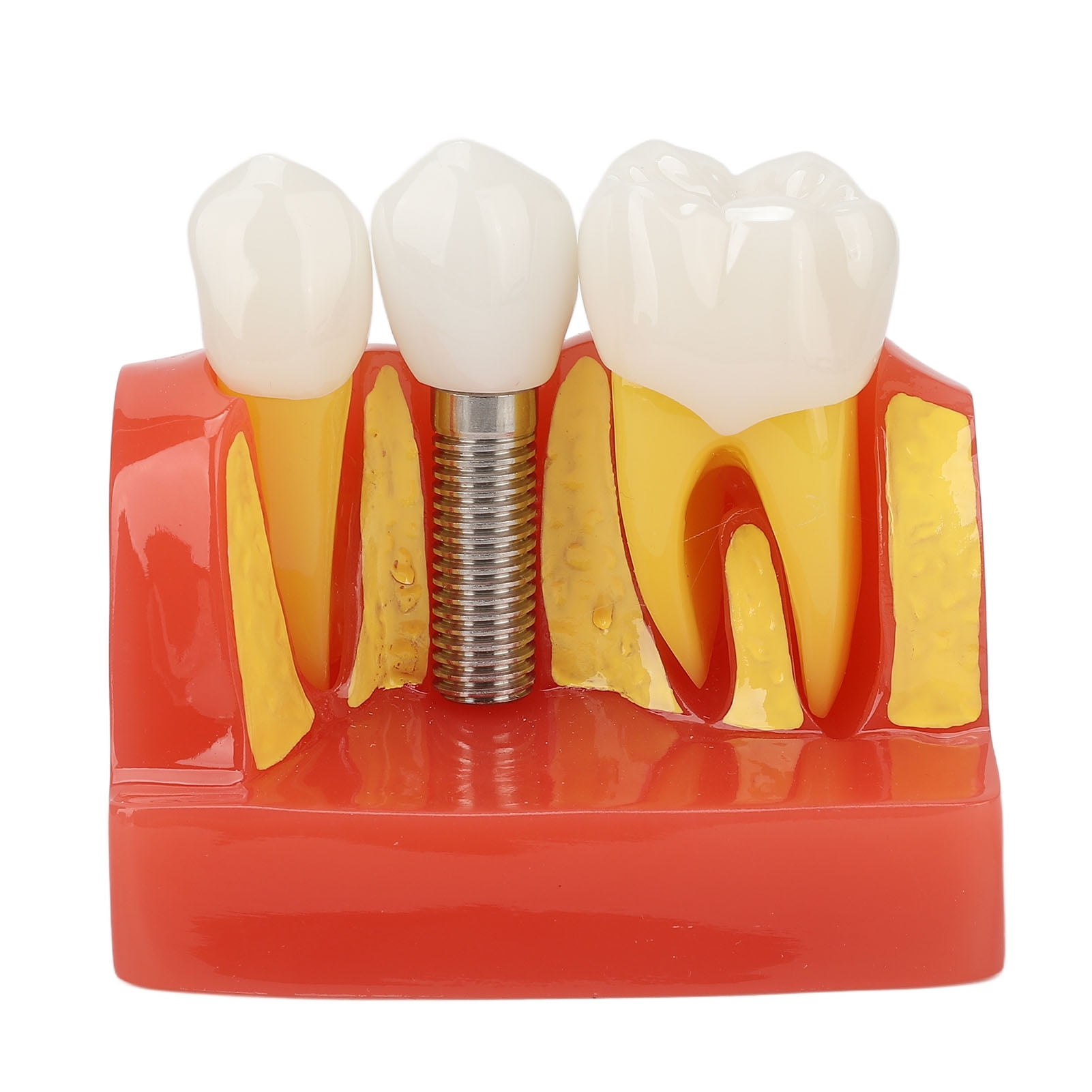 Removedor Divisor De Coronas Dentales - Elevador Para Puentes, Instrumento Dental SOP Instruments