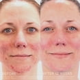 thumbnail image 3 of Tratamiento para el acné Rodan + Fields Unblemish Dual Intensive, 3 of 6