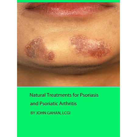 Natural Treatments for Psoriasis and Psoriatic Arthritis -