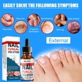 thumbnail image 3 of Nail fungo treatment - soluciones antifúngicas y tratamientos de hongos de uñas bajo las uñas - reparación de dedos y uñas CAIXIN Solución reparadora para uñas, 3 of 6