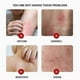 thumbnail image 2 of Sulfur Anti-bacterial Cream 20g, Suitable For Itching, Mite Bites, Inflammatory Skin Irritation, 2 of 5