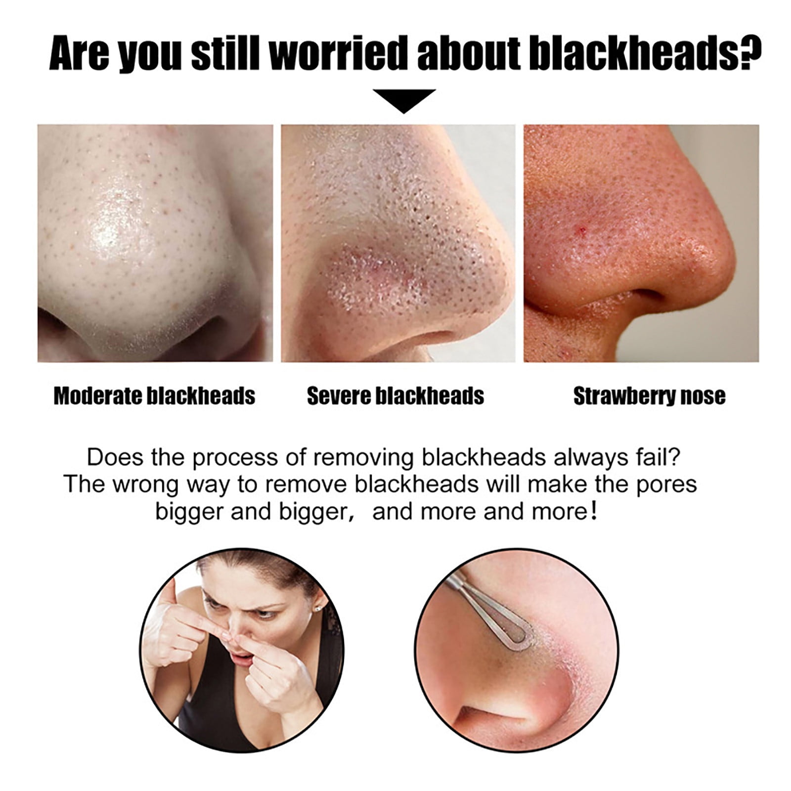 BLACKHEAD REMOVAL (にきび除去) 角栓除去】超絶変化！大量のニキビを芯出しするって気持ちいい