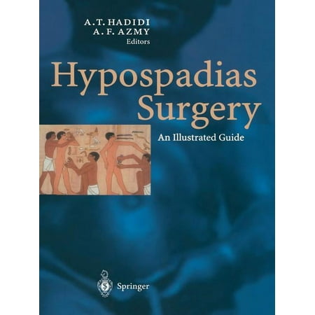 UPC: 9783662078433 | Hypospadias Surgery: An Illustrated Guide (Paperback)