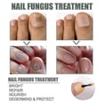thumbnail image 2 of Extra Strong Nail Fungus Treatment, Best Nail Repair Stop Fungal Growth Effectiv Tw, 2 of 2