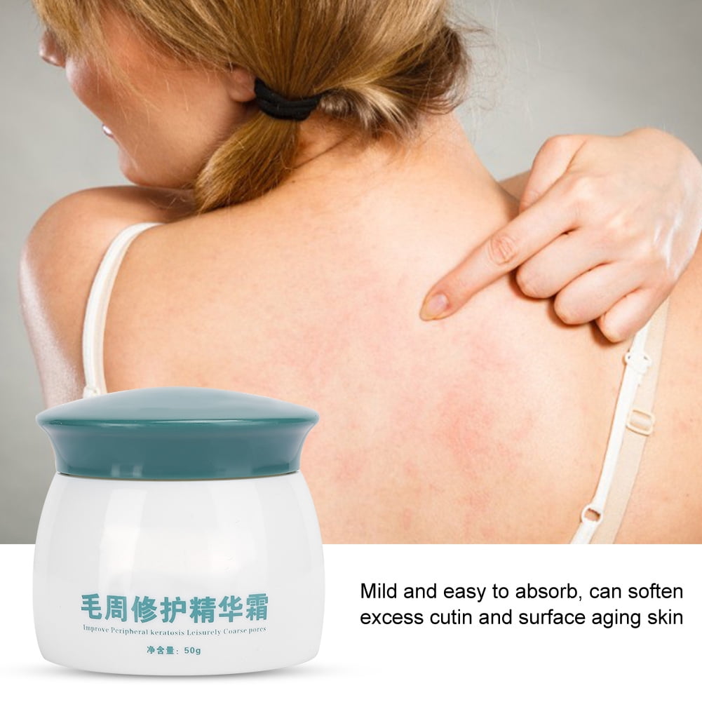 Keratosis Pilaris Cream, Professional Keratosis Pilaris Cream Body Soothing Chicken Skin