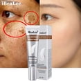thumbnail image 2 of IBeaLee-crema blanqueadora para pecas, elimina Melasma, elimina manchas oscuras, melanina, eliminador de Melasma, ilumina la piel, antienvejecimiento Fivean unisex, 2 of 2