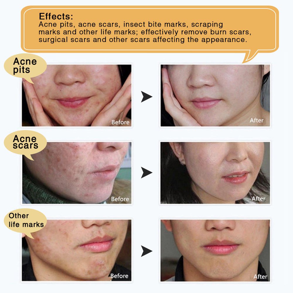 LanBeNa Pimple Scar Acne Mark Spots Removal Treatment Gel Ointment Blemish Cream - image 5 of 8