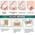 thumbnail image 4 of 100 piezas de pegatinas correctoras de uñas, parche corrector de uñas encarnadas, resistente al agua, tratamiento de paroniquia, herramienta de pedicura correctora de recuperación, 4 of 5