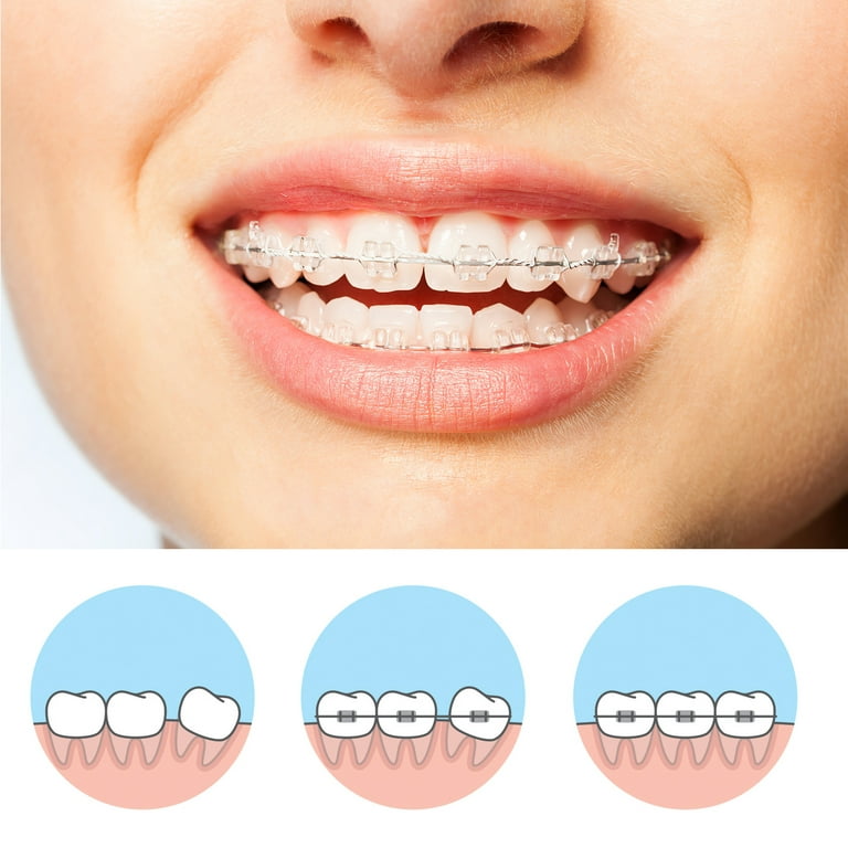 How to Use Wax for Braces: A Complete Guide