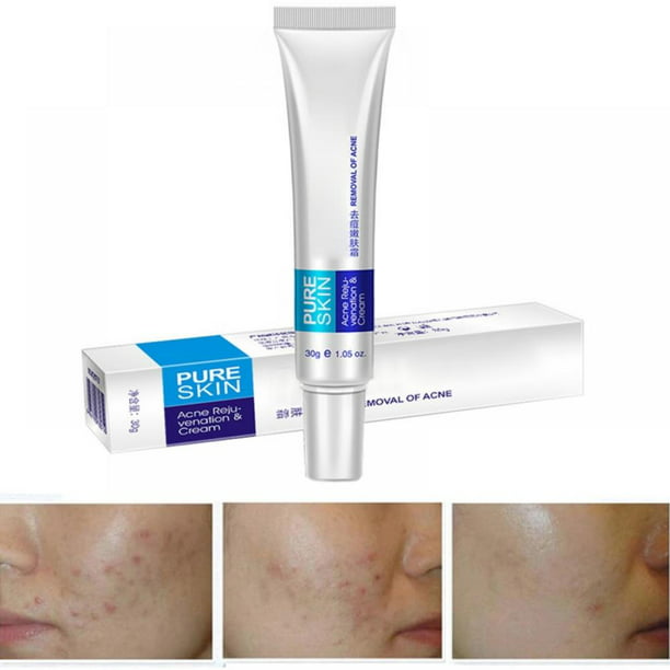 Willen Uitsluiten Ten einde raad 1/2PCS Removal Acne Scar Treatment Maquiagem Face Mask Cream Moisturizing  Facial Care - Walmart.com