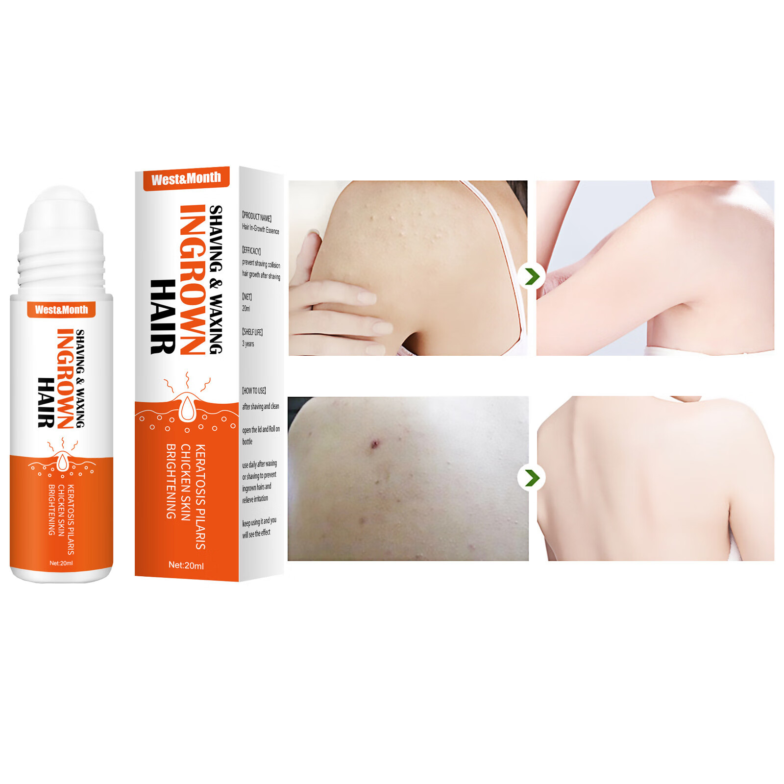 LBS Care Shave Burns for Ingrowns The Hair for Unsightly Burns Solution