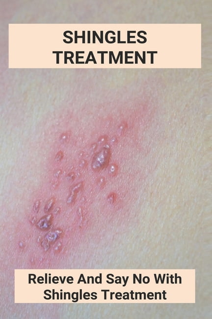 Shingles Treatment : Relieve And Say No With Shingles Treatment 