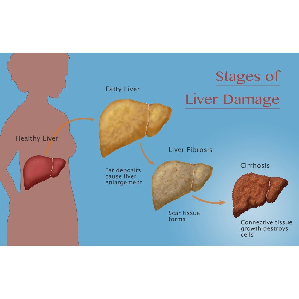Stages of Liver Damage Poster Print by Monica Schroeder/Science Source