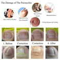 thumbnail image 4 of Toenail Correction Tool  Toenail Recover Tool  Foot Care Tool 6 In 1 Set Ingrown Toe Nail Fixer Pedicure Toenail Recover Correction Tool Nail Foot Care 02#, 4 of 8
