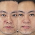 thumbnail image 4 of Tratamiento para el acné Rodan + Fields Unblemish Dual Intensive, 4 of 6