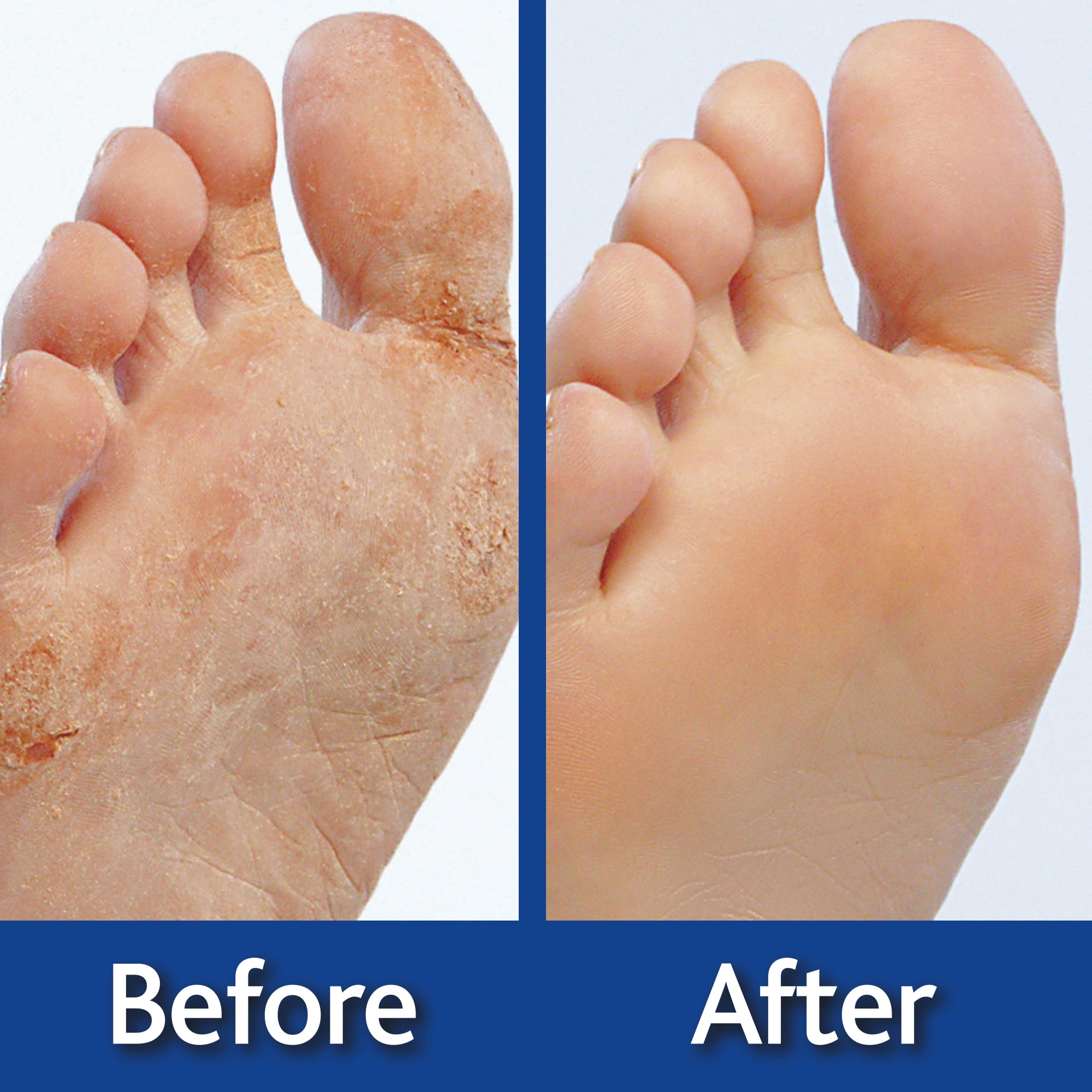 Genie Feet Exfoliating Foot Peel Cream for Smooth Beautiful feet, 4 oz.