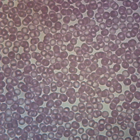 Human Iron Deficiency Anemia  Smear Microscope Slide price history on PriceWatchPro