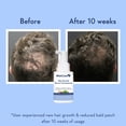 thumbnail image 4 of WishCare Hair Growth Serum Concentrate - 3% Redensyl, 4% Anagain, 2% Baicapil, Caffeine, Biotin, Plant Keratin & Rice Water - Hair Growth Serum for Men & Women, 30 ml, 4 of 4