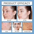 thumbnail image 2 of Suitable for Acne Redness Killer Deep-Cleaning Moisturizing Natural Acne Clearing Cream for Women & Men 1-3pcs-jc, 2 of 5