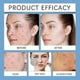 thumbnail image 2 of Suitable for Acne Redness Killer Deep-Cleaning Moisturizing Natural Acne Clearing Cream for Women & Men 1-3pcs-jc, 2 of 5