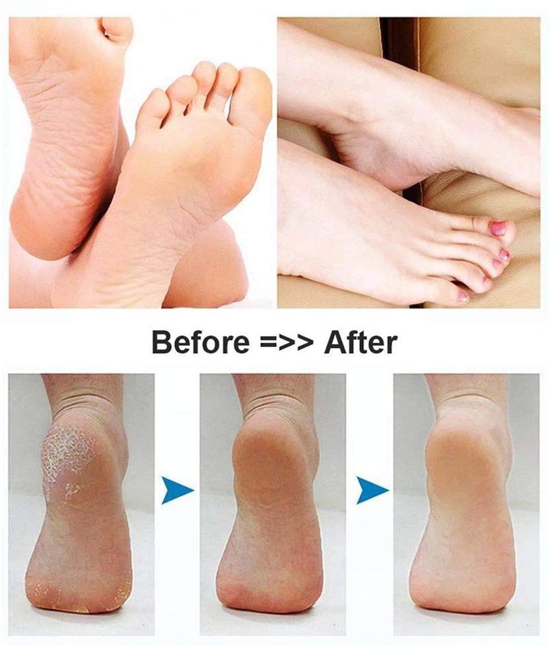 LNKOO Electric Foot Callus Remover Kit Rechargeable callous removers 2 Grinding Heads Portable Waterproof foot file, Professional Pedicure Tools Feet Care for Dead Hard Cracked Dry Skin