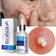 thumbnail image 5 of Serum Anti Acné UNIVERSOENLINEA.COM Bioaqua Pure Skin Cuidado Facial 1 Pieza, 5 of 8