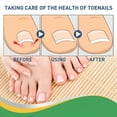 thumbnail image 3 of XIRQI 2026 New 100Pcs Ingrown Toenail Corrector Sticker Foot Care Paronychia Treatment Pedicure Foot Orthodontic Toe Thumb Nail Care Patches for Men & Women for Foot, Toenail, Pedicure, Home, Salon, 3 of 7