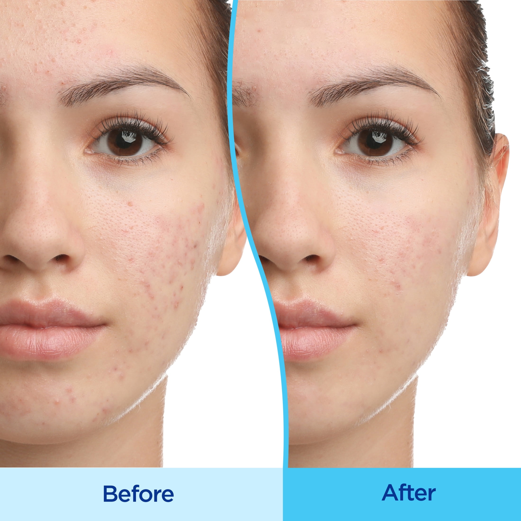 Differin Acne Treatment Gel, Retinoid Treatment for Face with 0.1% Adapalene, Gentle Skin Care for Acne Prone Sensitive Skin, 1.6 OZ