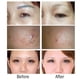 thumbnail image 5 of Pluma para eliminar manchas, Spot Eraser Pro Manchas Cara Eliminación Plasma Pen Facial Machine Tratamientos Para Manchas Piel con gafas, 9 tipos Frecuencia de trabajo(EU) (US) Protección de La Piel Octpeak NO, 5 of 7