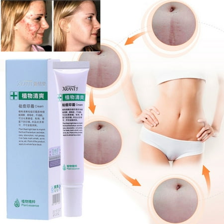 Soft Cream Freckle Cream Extract Acne Removal Scars Marks Treatment Facial (Best Freckle Removal Cream Review)