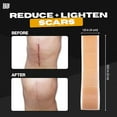 thumbnail image 7 of Skin Grip Medical Grade Silicone Scar Tape 1.6"x120" Roll –Increased Strength & Reduced Irritation – Silicone Scar Sheets for Face, Surgical Scars, C-Section, Keloid, Tummy Tuck, Burn - Skin, 7 of 7