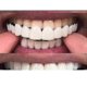 thumbnail image 1 of New Dental False Teeth Cover Perfect Smile Veneers Comfort Fit Flex Denture Teeth, 1 of 2
