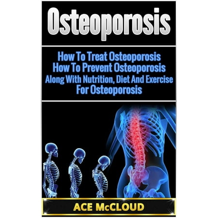 Osteoporosis: How To Treat Osteoporosis: How To Prevent Osteoporosis: Along With Nutrition, Diet And Exercise For Osteoporosis -