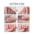 thumbnail image 4 of Nail Fungus Treatment for Toenails, Toenail Fungus Treatment, Extra Strength Nail Fungus Treatment For Fingers & Toenai, 4 of 5