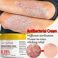 thumbnail image 5 of Crema antihongos para Psoriasis, tratamiento de infección por hongos para la piel, crema médica para Psoriasis, pomada para el tratamiento de picazón de la piel, 5 of 5