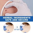 thumbnail image 1 of Removedor de verrugas Skin Tag Pen Professional Papillomas Moles Removal Pen (02) Ndcxsfigh Cuidado Belleza, 1 of 4