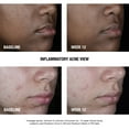 thumbnail image 4 of Neutrogena Stubborn Acne AM Treatment with Benzoyl Peroxide, 2.0 oz, 4 of 11