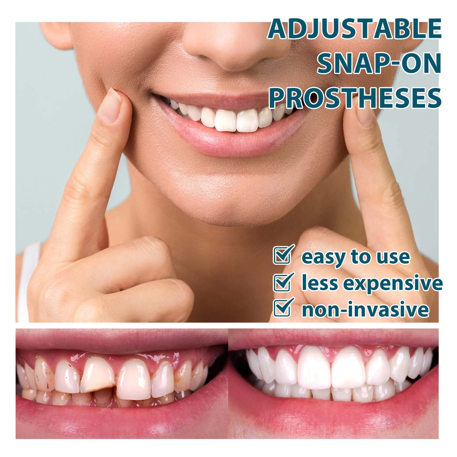 Alvantor Adjustable Buckle Teeth Kit, Temporary Fillings & Interdental Fillings, 1 Pair
