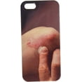 thumbnail image 1 of Psoriasis on Elbow. Medical Treatment Cell Phone Cover case iPhone5, 1 of 1