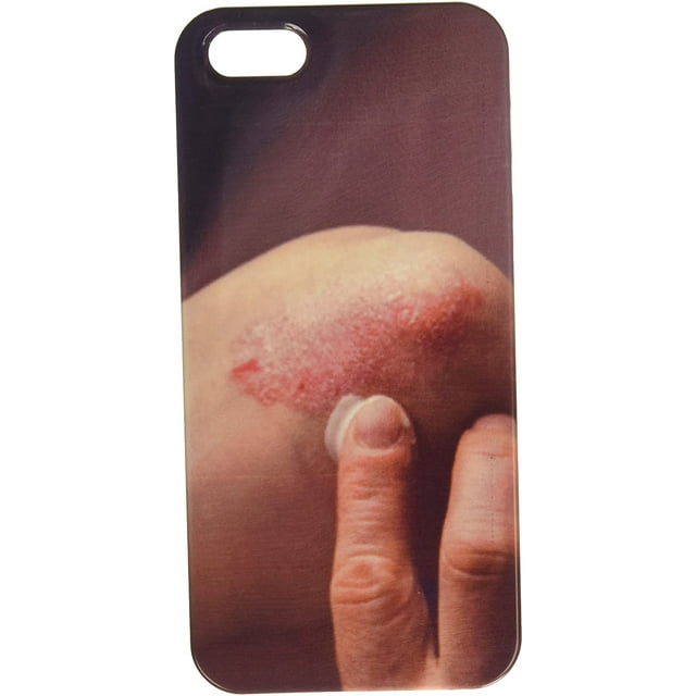Psoriasis on Elbow. Medical Treatment Cell Phone Cover case iPhone5